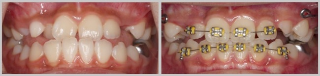 Growth modification before and after photo