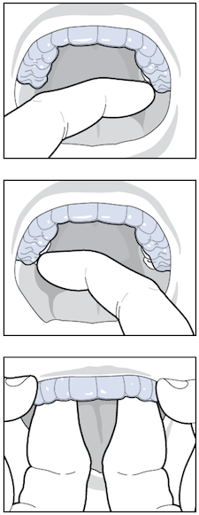 invisalign photo 3