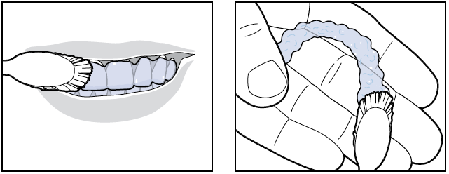 invisalign photo 4